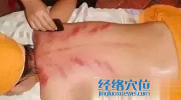 刮痧示范圖
