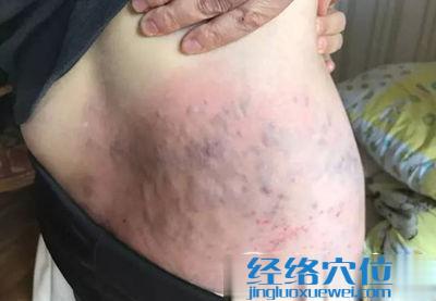 拍打八髎穴出痧圖參考