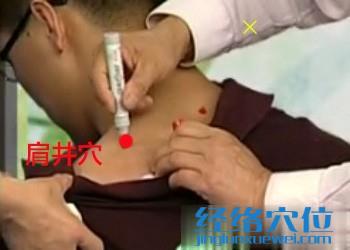 療落枕的穴位：肩井穴位