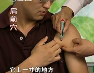 肩前穴的準(zhǔn)確位置圖