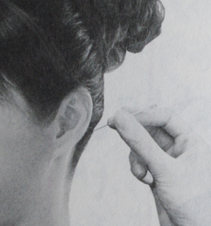 針刺風(fēng)府穴