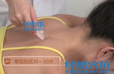 刮痧的方法：雙角刮法示意圖