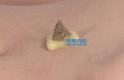 艾灸的方法：隔葁灸的示范圖