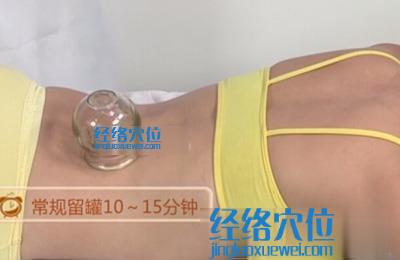 拔罐的方法：留罐法示范圖