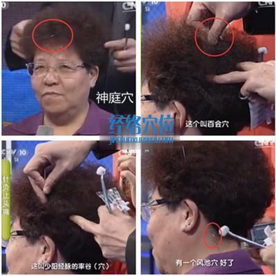 王教授現(xiàn)場演示，針灸穴位止頭痛